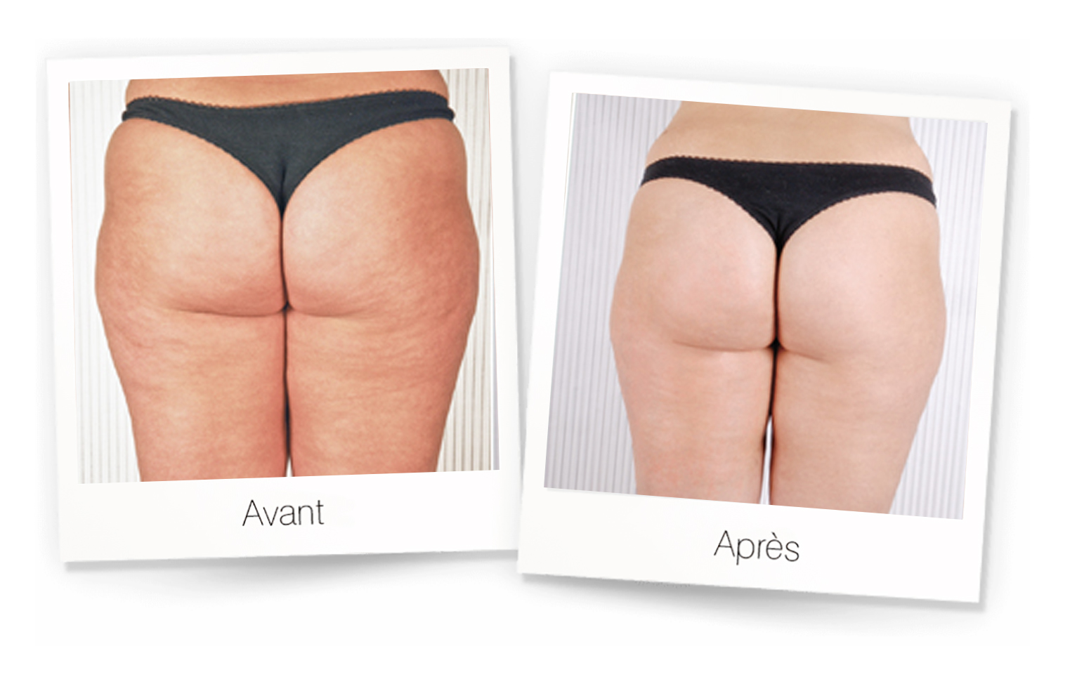 mpr-avant-apres MPR anti cellulite